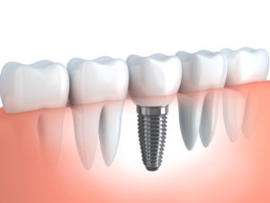 implantologia-odontoiatrica-dental-academy
